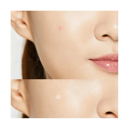 Cosrx Acne Pimple Master Patch | Happymetime